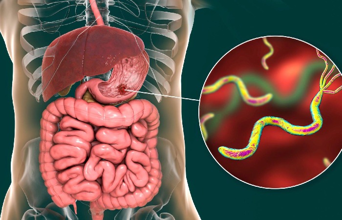 Meckel's Diverticulum